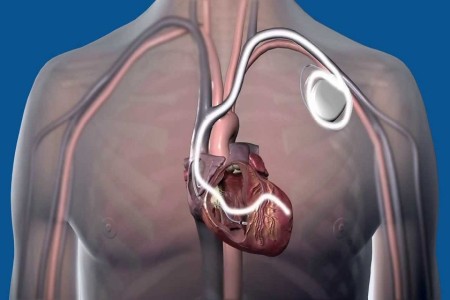Eseguito il primo impianto in Sardegna di pacemaker senza fili per via giugulare